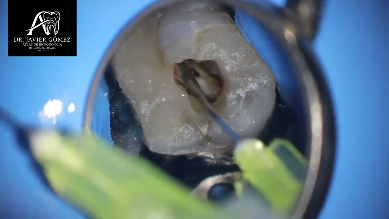 Vista de un conducto radicular a través del microscopio dental